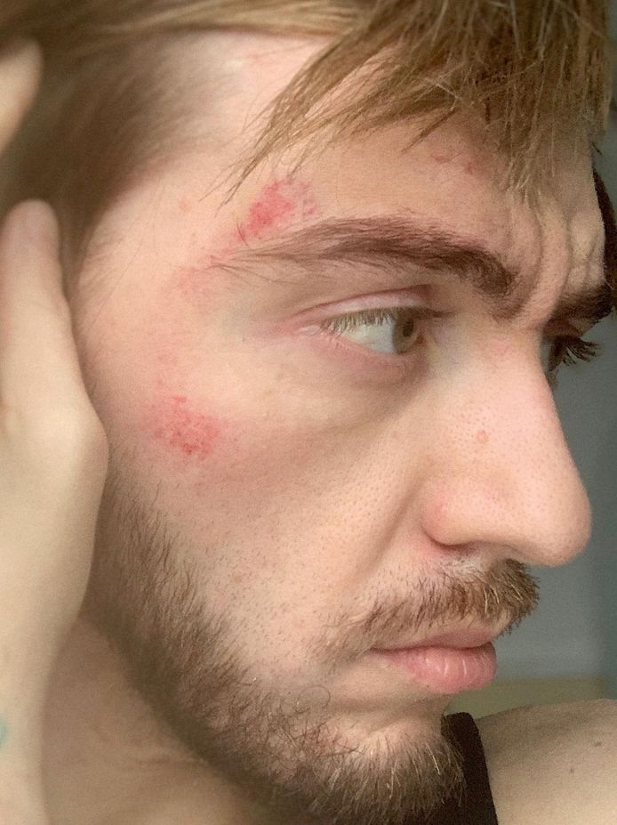 Eric a subi des séquelles de l'agression homophobe dont il a été victime à Charleroi