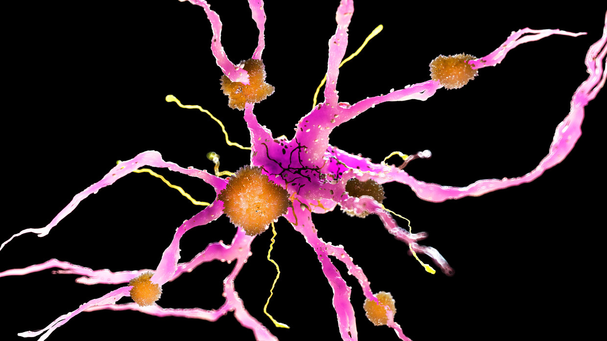 Amyloid-eiwitten op een zenuwcel. Beeld Hollandse Hoogte / Science Photo Library