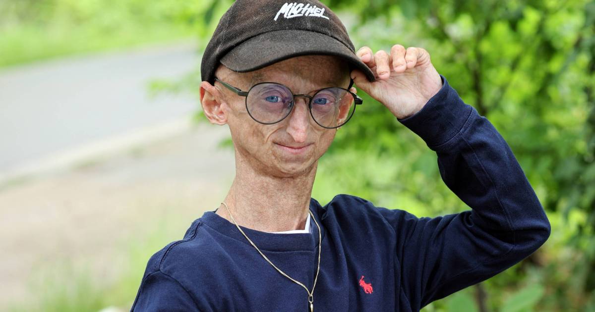 Progeria Patient Michiel Vandeweert Celebrates 25th Birthday after Open