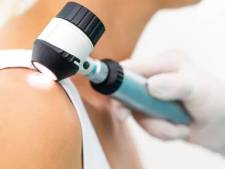 Une recherche d'UZ Brussel confirme les bienfaits de l'immunothérapie pour le cancer de le peau