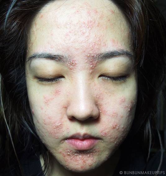 L'horrible allergie cutanée d'une bloggeuse après un soin du ...