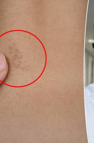 Elk jaar worden in ons land 50 kinderen geboren met neurofibromatose: “Pas op volwassen leeftijd zijn de kleine gezwelletjes zichtbaar op de huid”