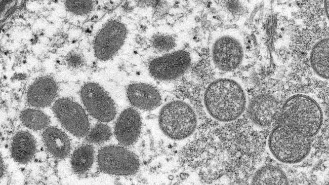 Eerste apenpokkenvirusgevallen in Zwitserland en Israël, ook Noorwegen start onderzoek naar mogelijke uitbraak