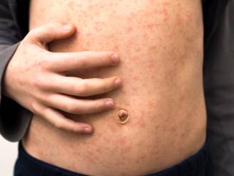 Mazeleninfecties in het Verenigd Koninkrijk stijgen aan alarmerend tempo: experts maken zich zorgen