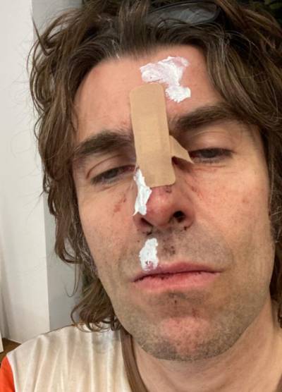 Liam Gallagher toont zwaar gehavend gezicht op Twitter: “Ik ben uit een helikopter gevallen”