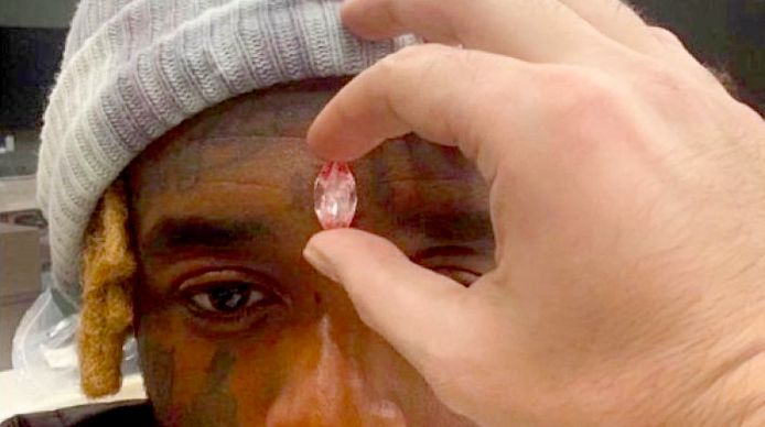 Lil Uzi Vert verdedigt via sociale media de diamant die hij in zijn voorhoofd liet implanteren.