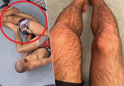 KIJK. “Ik voelde knie wel zeven keer kraken”: UFC-vechter weigert op te geven nadat been hélemaal plooit, maar deze foto toont de gevolgen