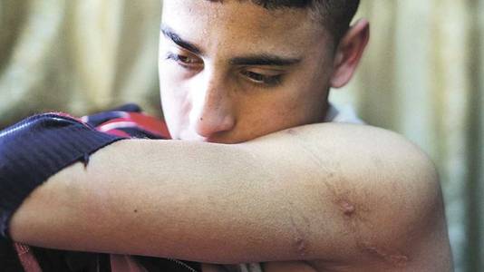 Hamzes Abu Hashem toont de littekens van de hondenbeten. Volgens zijn advocaat heeft hij ernstige psychische klachten na de aanval. Foto: Alex Levac.