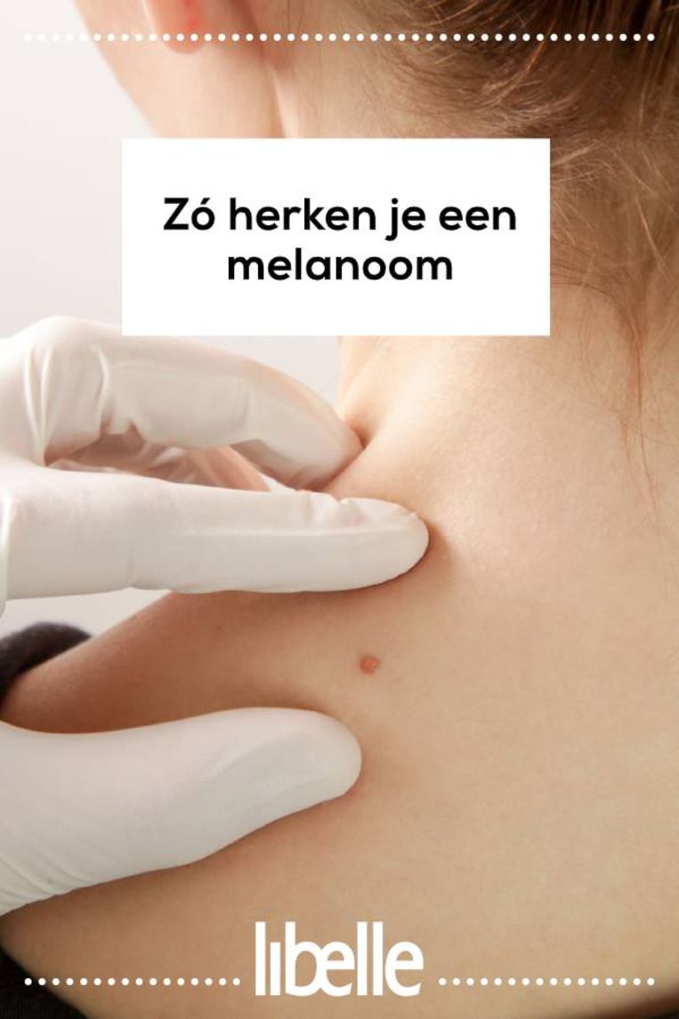 Zó herken je een melanoom | Libelle