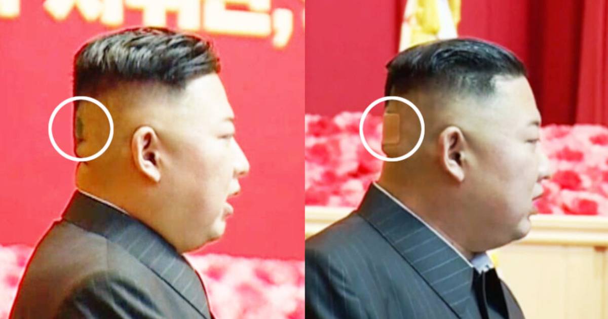 El misterio de la salud de Kim Jong-un sigue creciendo: líder con una venda en la cabeza visto |  En el extranjero