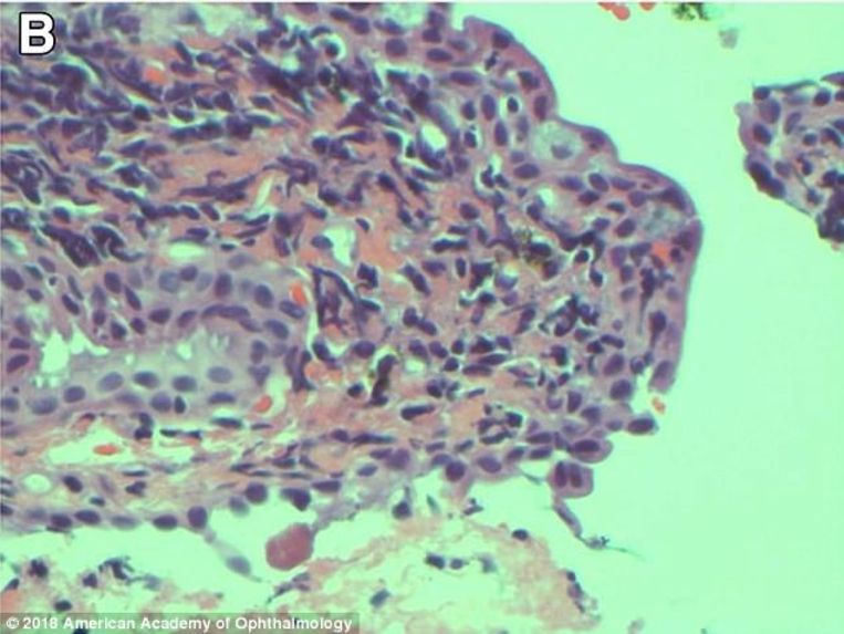 null Beeld © 2018 American Academy of Ophthalmology
