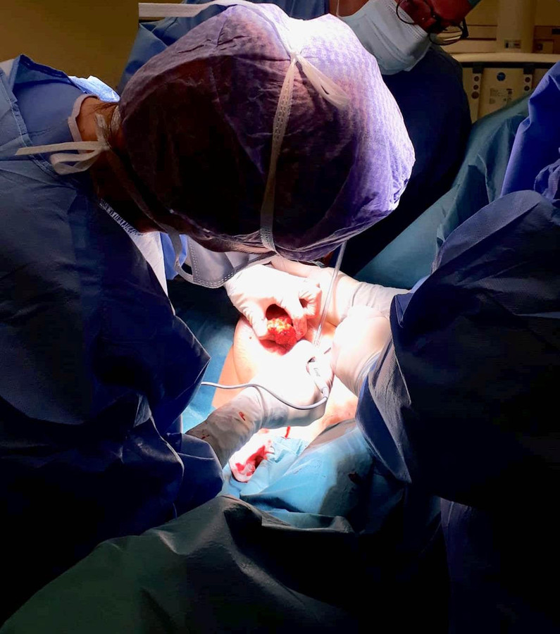 Met een speciaal apparaatje zoeken chirurgen van het ADRZ naar het jodiumzaadje en dus de tumor in een borst.