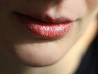 Sommige lippenbalsems maken het érger: tips van dermatoloog die wel werken tegen droge lippen