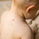 Minder ouders laten hun kind vaccineren