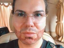 Straks ook de Kin-stylist van het Zuiden: Roy Donders ondergaat baardtransplantatie