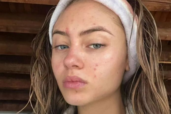 Leni Klum toont haar acne op Instagram.