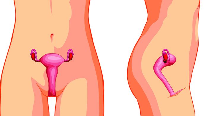 Sterilisatie Vrouwen Kan Binnen Paar Minuten Wonen Bd Nl