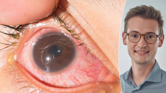 “Soms is een bloedafname, longfoto of oogpunctie nodig”: irisontsteking is meest voorkomende oogontsteking. Hoe herken je de symptomen?