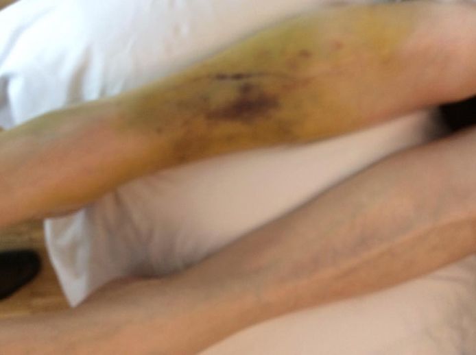 Zo ziet het been van Leona Vanaeken eruit op zondag 23 april 2017.