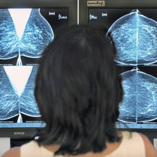 Sterke stijging kankerdiagnoses niet meer te stoppen vanwege vergrijzing en leefstijl