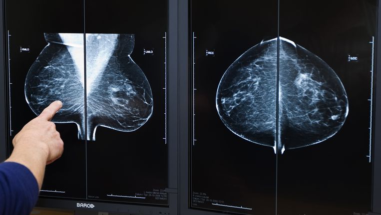 Archieffoto, röntgenfoto van een borst met een tumor. Beeld anp