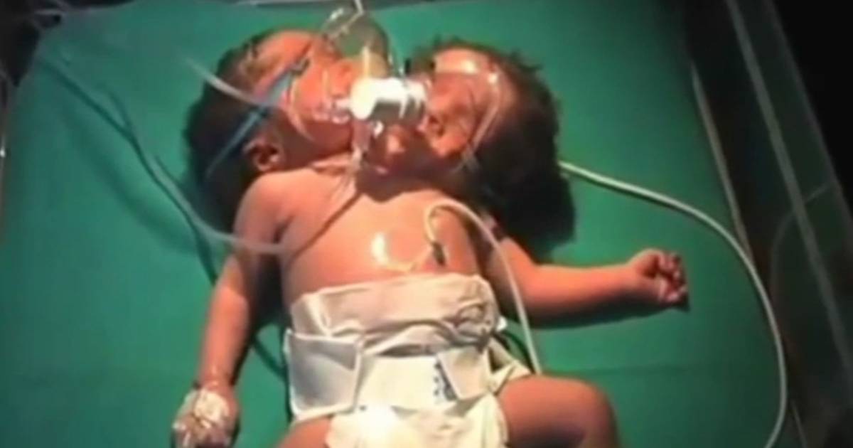 La Mere Du Bebe A Deux Tetes Trop Choquee Pour Le Voir Famille 7sur7 Be
