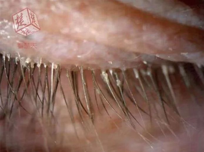 In de wimpers van de patiënte werden honderden mijten ontdekt waardoor ze haar ogen niet meer kon openen.