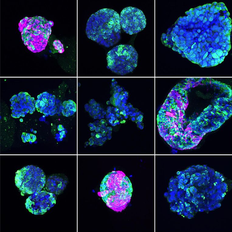 Zogeheten organoïden van borstkankercellen van verschillende patiënten. De kleuren duiden op uiteenlopende celtypen. Beeld Norman Sachs