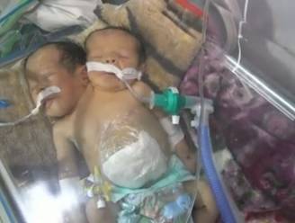 Schrijnend: Siamese tweeling kan Jemen niet uit voor behandeling en sterft