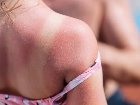 Is aftersun zonde van het geld? Expert legt uit wat je moet doen als je verbrand bent door de zon