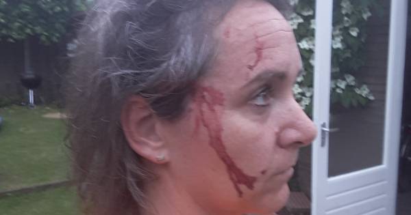 Gezicht van Suzanne onder het bloed door aanval roofvogel: '5 centimeter naar voren en ik had geen o