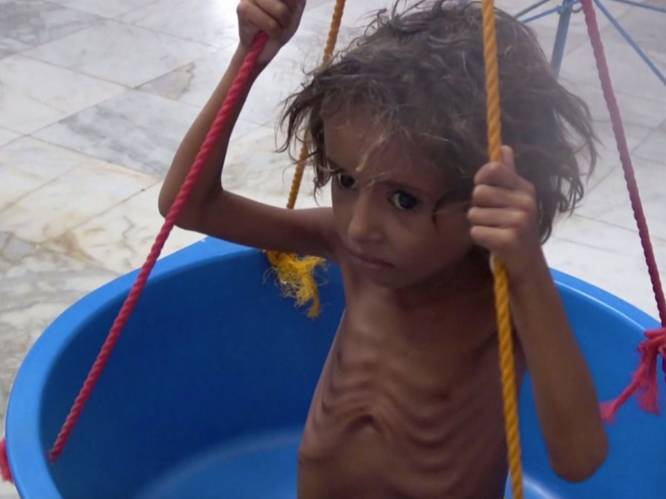 Schrijnende beelden: kinderen in Jemen zwaar ondervoed door burgeroorlog