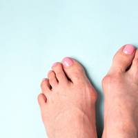Oud-fysiotherapeut vertelt: zo ontstaat hallux valgus