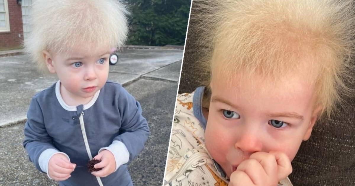 “All’inizio pensavo che qualcosa non andava”: sua madre condivide le foto di suo figlio con la sindrome dei capelli incontrollabili |  sapere