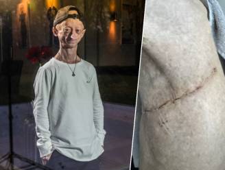 Progeriapatiënt Michiel (24) herstelt van openhartoperatie: “Er was geen hartklep in mijn maat... De chirurg heeft al mijn ribben moeten openbreken”