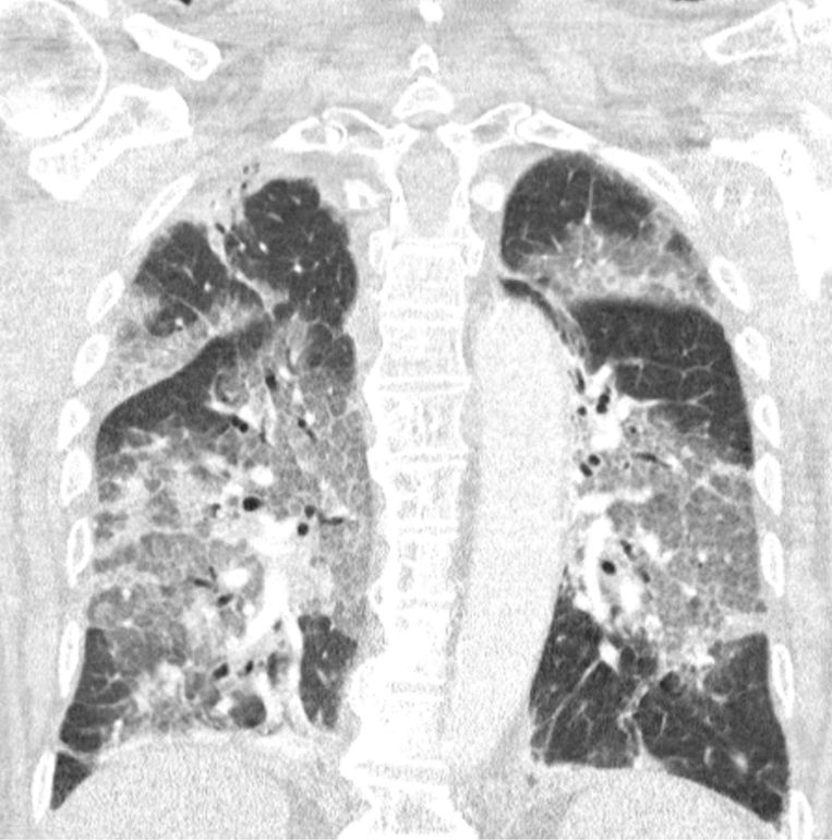 Vaccinweigeraar met spijt ‘Mijn ogen zijn geopend. Ik ben gered door