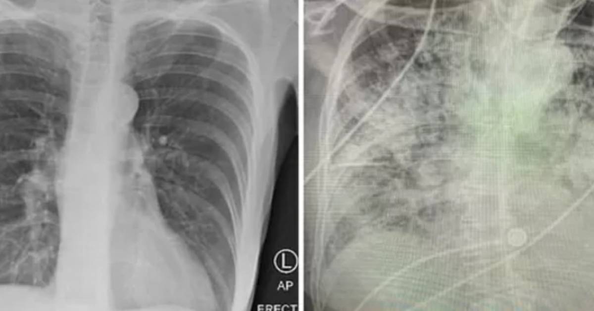 La Radiographie Des Poumons D Un Patient Infecte Par La Covid 19 Ils Sont Dans Un Pire Etat Que Ceux D Un Fumeur Sante 7sur7 Be