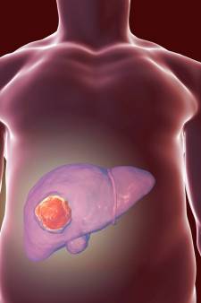 De plus en plus de cancers du foie détectés en Belgique: “La chimiothérapie n’aide pas à combattre cette maladie”