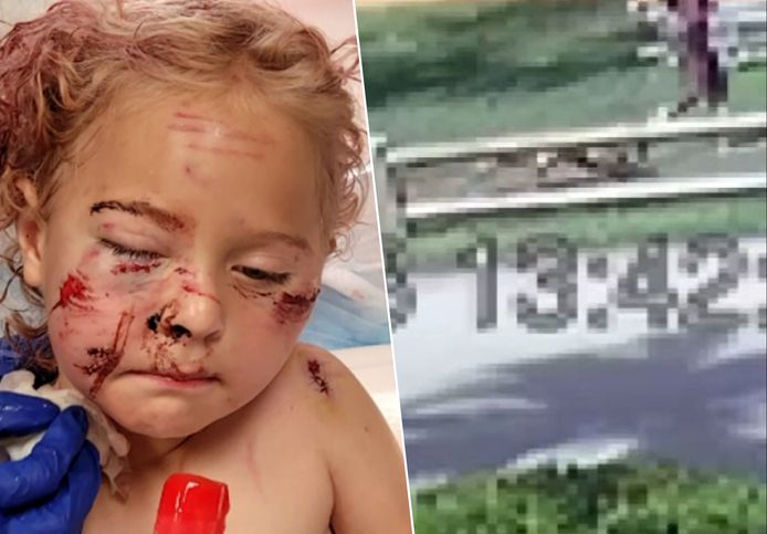 Een vijfjarig meisje zit vol hechtingen nadat ze in haar gezicht, rug en schouders werd gebeten door een hond.