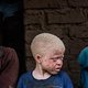 In verkiezingstijd worden albino's in Malawi vermoord voor geluksdrank