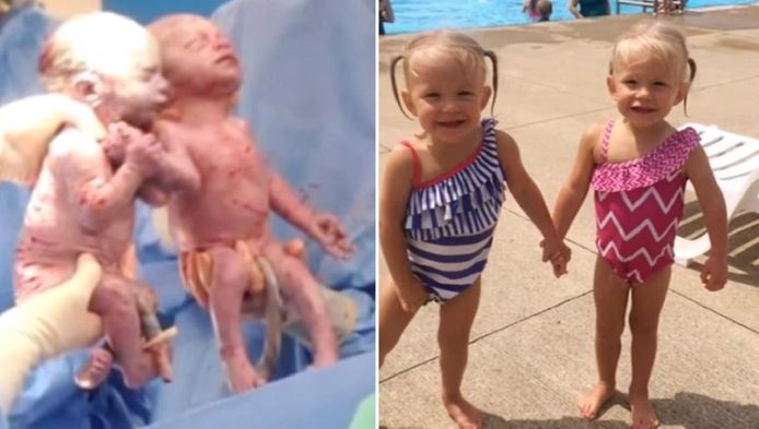 Twee Jaar Later Zeldzame Tweeling Nog Steeds Hand In Hand Wonen Ad Nl