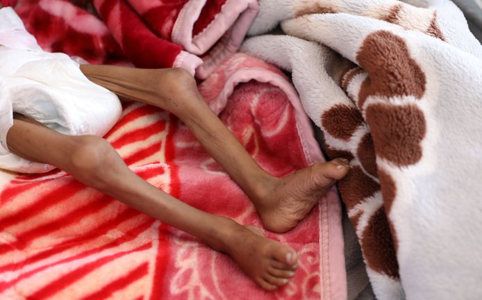 Een ondervoed meisje in een bed in het al-Sabeen-ziekenhuis.