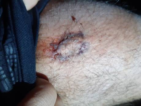 Agressieve Dordtenaar (32) bijt agent in bovenbeen
