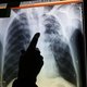 Het aantal tbc-besmettingen in België stijgt: ‘De situatie is precair’