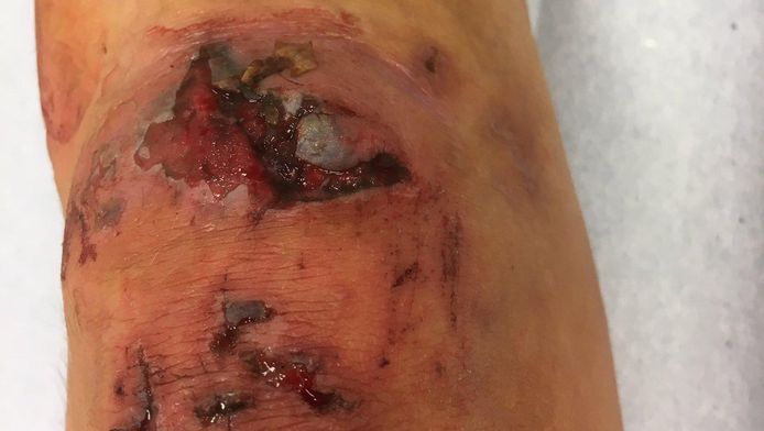 Met deze foto van verschrikkelijke knieblessure maakt ...