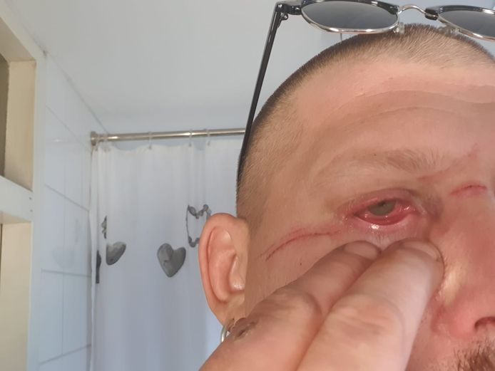 Brian Tas (41) uit Alphen raakte gewond aan zijn oog en gezicht toen hij op de scooter tegen een visdraard reed dat over de weg was gespannen