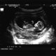 Foetaal weefsel mag na abortus bewaard worden om verkrachting te bewijzen