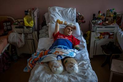 Aangrijpende beelden tonen leed van verminkte burgers in Oekraïense ziekenhuizen