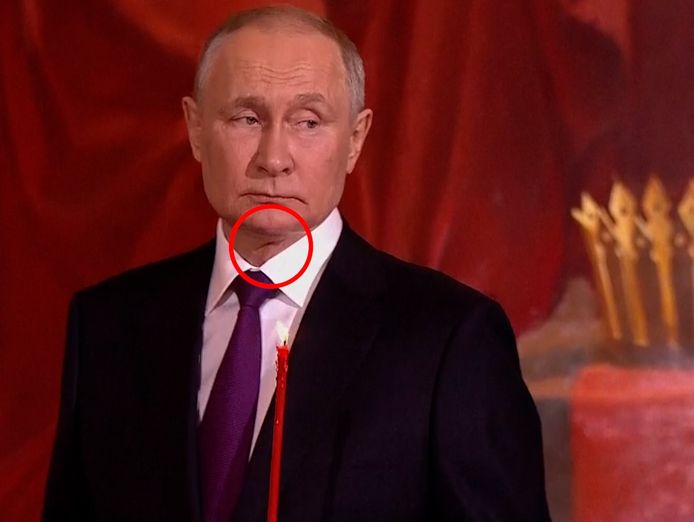 Poetin heeft op een foto van afgelopen zondag duidelijk een litteken in de hals.