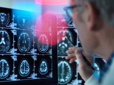 L'obésité aurait les mêmes effets sur le cerveau que la maladie d’Alzheimer